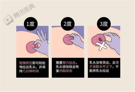 乳暈上一顆一顆|乳暈小顆粒與乳頭硬塊：可能是乳腺問題嗎？